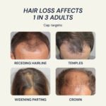 Hair Loss Treatment Areas Hairline Crown